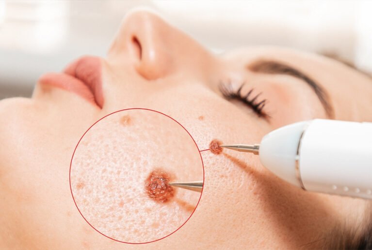 A safe and non-invasive removal treatment designed to eliminate unwanted skin tags, moles, or warts quickly and comfortably. Pricing starts at $99 for small spots under 3mm and $150 for larger areas, ensuring clear, smooth, and confident skin.