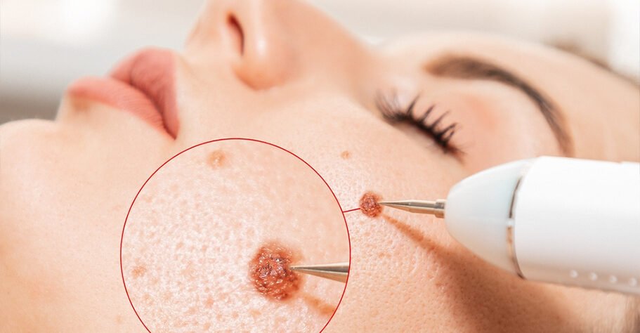 A safe and non-invasive removal treatment designed to eliminate unwanted skin tags, moles, or warts quickly and comfortably. Pricing starts at $99 for small spots under 3mm and $150 for larger areas, ensuring clear, smooth, and confident skin.