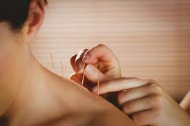 Acupuncture: Restoring Balance Through Natural Healing